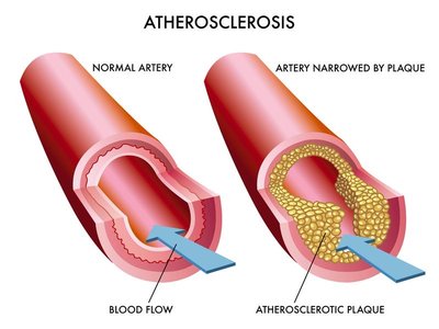 Diagram of atherosclerosis: normal artery vs. artery narrowed by plaque