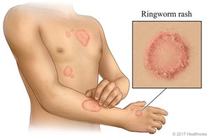 Ringworm rash on human skin