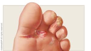 Athlete's foot infection between toes