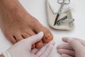 Fungal nail infection being examined