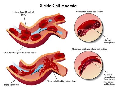 Diagram of sickle-cell anemia effects on blood flow