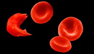 Sickle-shaped red blood cell compared to normal
