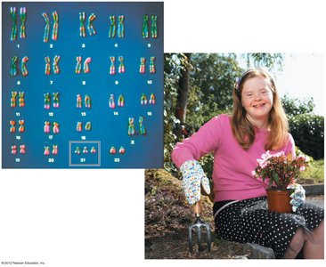 Karyotype of individual with Down syndrome (trisomy 21)