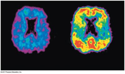 PET scans of healthy and Alzheimer's-affected brains