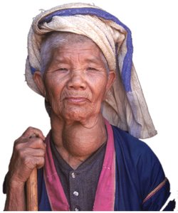 Person with goiter due to iodine deficiency