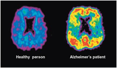 PET scan comparison: healthy person vs. Alzheimer's patient