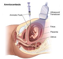 Amniocentesis procedure