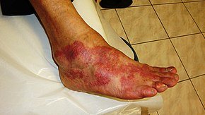 Inflamed finger showing redness and swelling