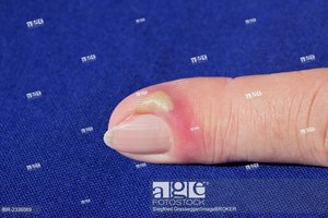 Pus formation in inflamed tissue