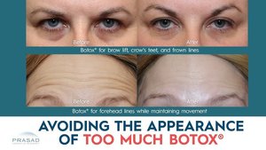 Before and after Botox treatment (forehead)