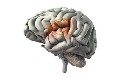 Brain with stroke area highlighted