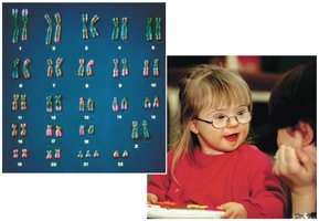 Karyotype of Down syndrome