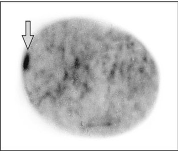 Barr body formation in female cell