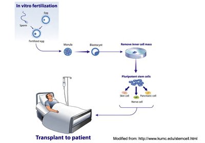 Therapeutic cloning for diabetes