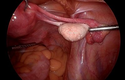 Laparoscopy image of ovary and fallopian tube