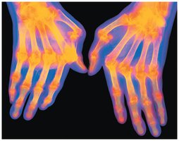 Thermal image of hands showing inflammation in autoimmune disease
