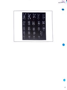 Human karyotype showing chromosomal abnormalities