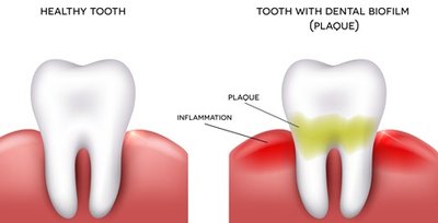 Dental biofilm (plaque)