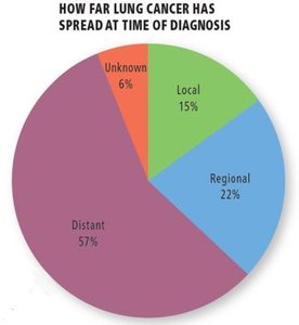 Pie chart showing lung cancer diagnosis stages