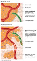 Benign vs. malignant tumor diagram