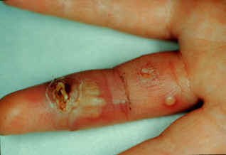 Inflammatory response at a wound site