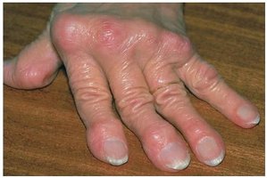 Rheumatoid arthritis