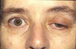 Myasthenia gravis