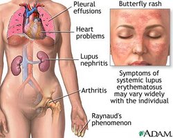 Lupus symptoms