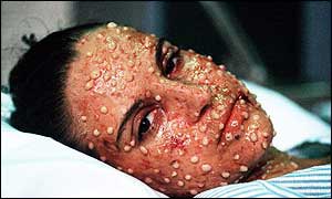 Smallpox vaccination