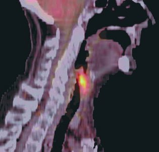 PET scan showing radioactive isotope use