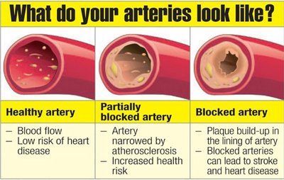 Artery health and plaque buildup