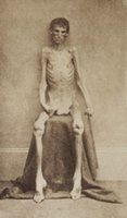 Severe undernourishment in a human