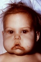 Kwashiorkor, a protein deficiency disorder in children