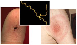 Lyme disease transmission and symptoms