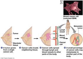 Growth and metastasis of a malignant breast tumor