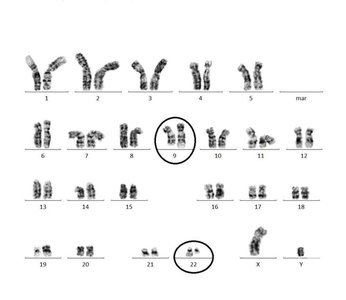 Karyotype showing Philadelphia chromosome