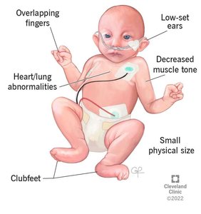 Edwards syndrome physical features