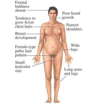 Klinefelter syndrome physical features