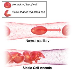 Sickle-cell anemia: normal vs sickle-shaped red blood cells