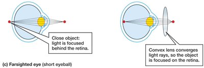 Farsighted eye correction
