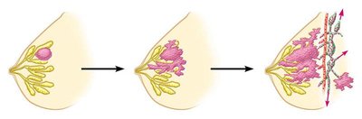Progression from benign tumor to metastasis