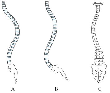 Illustrations of lordosis, kyphosis, and scoliosis