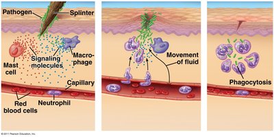 Fluid accumulation (edema)