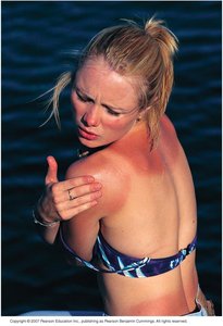 Person with sunburn, illustrating DNA damage by UV light