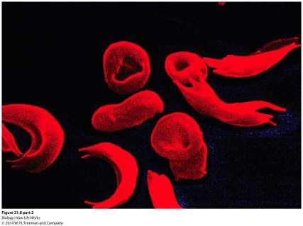 Sickle-shaped red blood cells