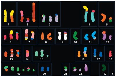 Karyotype of a female breast cancer cell