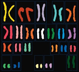 Normal karyotype