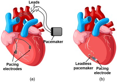 Diagram of pacemaker placement in the heart