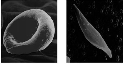 Normal vs. sickle-shaped red blood cells