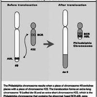 Philadelphia chromosome translocation and BCR-ABL fusion